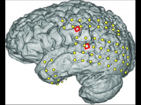 Magnetresonanzaufnahme des Gehirns: Die gr&uuml;nen Punkte zeigen, wo die Elektroden zur Suche nach den Epilepsieherden sitzen, die beiden roten Vierecke den Ort der MicroECoGs (Foto: Kai Miller, University of Washington)