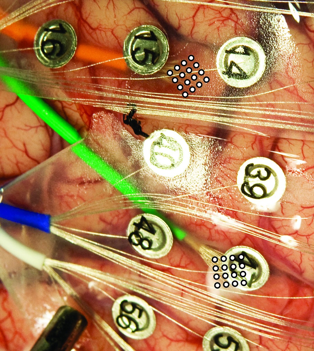Bild des Gehirns mit Elektroden. Die MicroECoGs sitzen am Ende des orangefarbenen und des grünen Drahtes (Foto: University of Utah Department of Neurosurgery)