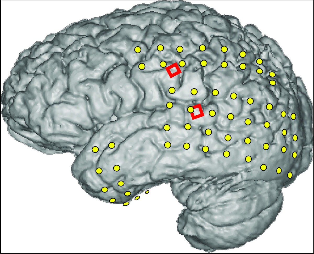 Magnetresonanzaufnahme des Gehirns: Die grünen Punkte zeigen, wo die Elektroden zur Suche nach den Epilepsieherden sitzen, die beiden roten Vierecke den Ort der MicroECoGs (Foto: Kai Miller, University of Washington)
