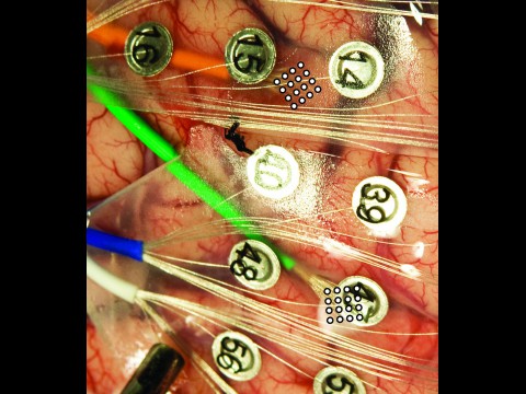 Bild des Gehirns mit Elektroden. Die MicroECoGs sitzen am Ende des orangefarbenen und des grünen Drahtes (Foto: University of Utah Department of Neurosurgery)