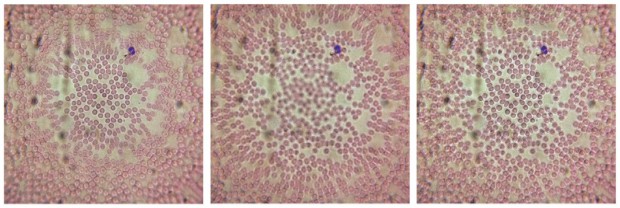Rote Blutkörperchen, aufgenommen mit dem iPhone-Mikroskop. Rechts: kombiniertes Bild aus linker und mittlerer Fokussierung (Bild: UC Davis/Plosone.org/CC BY 2.5)