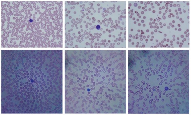 Obere Bildreihe: kommerzielles Mikroskop. Unteres Bild: iPhone-Mikroskop mit rechts Sichelzellanämie und Mitte Eisenmangelanämie (Bild: UC Davis/Plosone.org/CC BY 2.5)