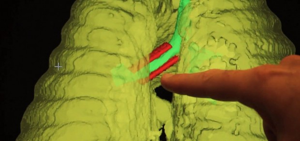 Das Implantat (rot) auf einer Hauptbronchie des Kindes (grün) (Bild: Uni Michigan)