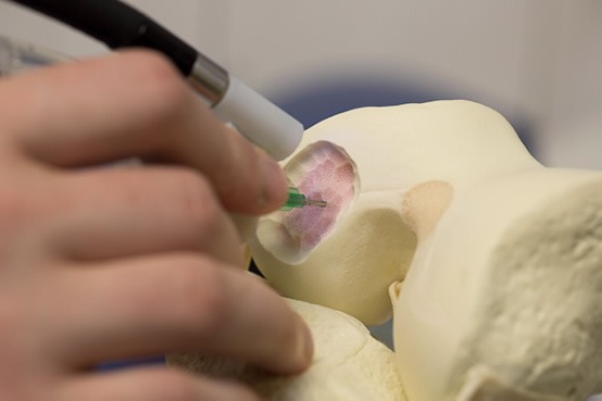 Der Biopen wird vom Mediziner per Hand wie ein Stift geführt. (Bild: University of Wollongong (UOW))